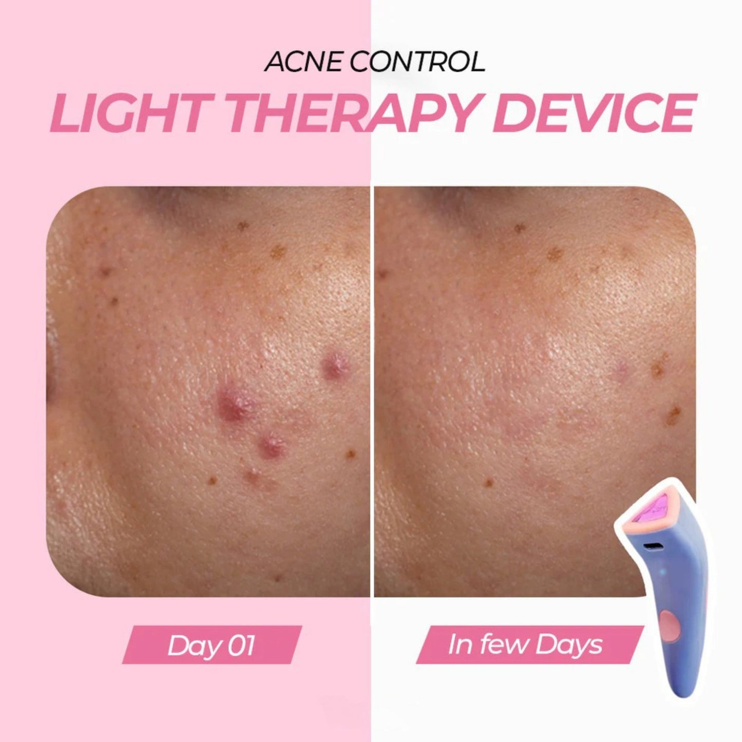 Red Light Acne Remover