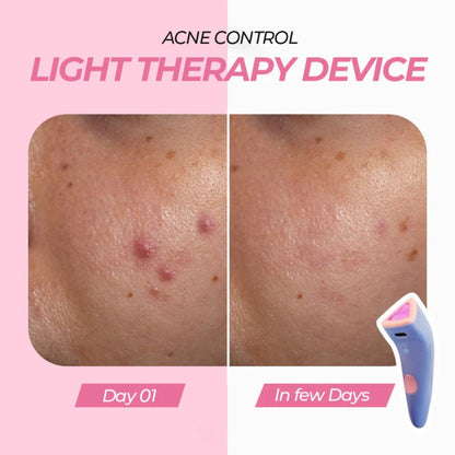 Red Light Acne Remover